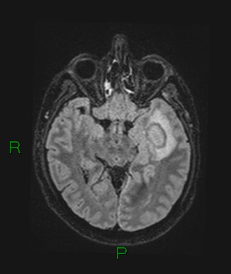 Cerebral abscess and subdural empyema (Radiopaedia 84436-99779 Axial FLAIR 50).jpg