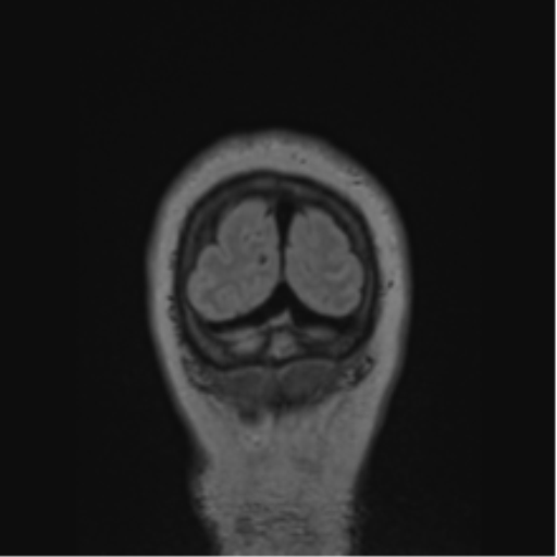 Cerebral abscess from pulmonary arteriovenous malformation (Radiopaedia 86275-102291 Coronal FLAIR 11).png