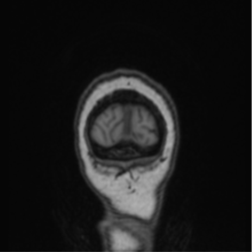 Cerebral abscess from pulmonary arteriovenous malformation (Radiopaedia 86275-102291 Coronal T1 8).png