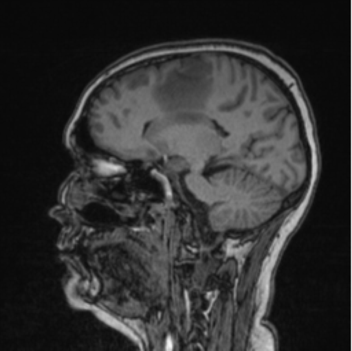 Cerebral abscess from pulmonary arteriovenous malformation (Radiopaedia 86275-102291 Sagittal T1 59).png