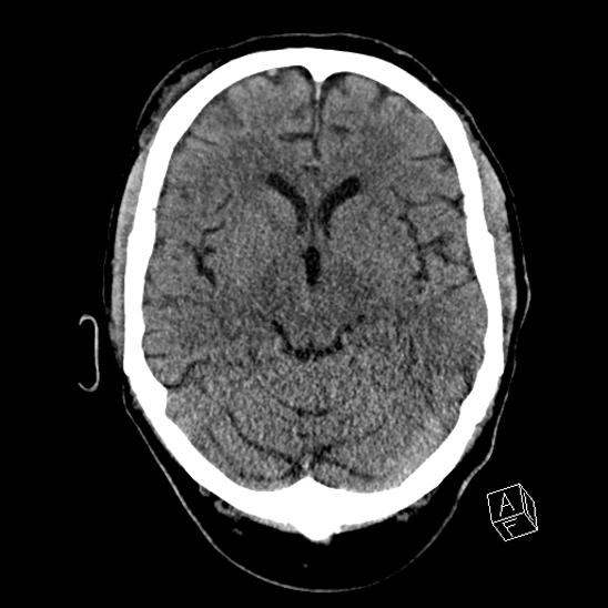 File:Cerebral abscess with ventriculitis (Radiopaedia 78965-91876 Axial non-contrast 22).jpg