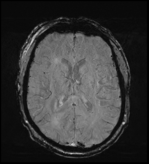 Cerebral abscess with ventriculitis (Radiopaedia 78965-91878 Axial SWI 31).jpg