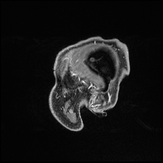 Cerebral abscess with ventriculitis (Radiopaedia 78965-91878 Sagittal T1 C+ 14).jpg