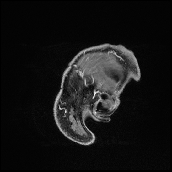 Cerebral abscess with ventriculitis (Radiopaedia 78965-91878 Sagittal T1 C+ 173).jpg