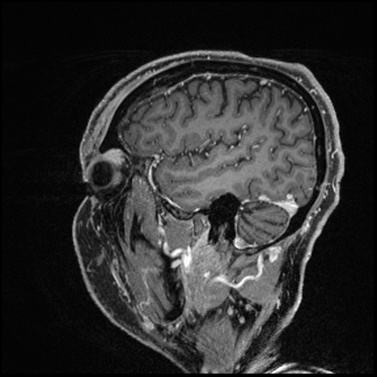 Cerebral abscess with ventriculitis (Radiopaedia 78965-91878 Sagittal T1 C+ 43).jpg