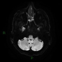 File:Cerebral amyloid angiopathy (Radiopaedia 77506-89664 Axial DWI 7).jpg