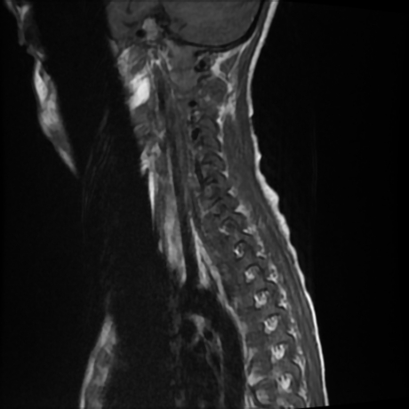 File:Cerebral and spinal tuberculosis (Radiopaedia 90489-107838 Sagittal T1 2).jpg