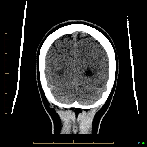Cerebral arteriovenous malformation (AVM) (Radiopaedia 78162-90706 Coronal non-contrast 83).jpg
