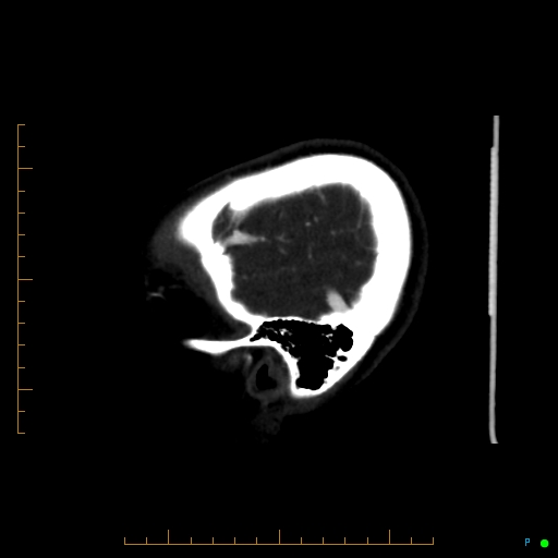 Cerebral arteriovenous malformation (AVM) (Radiopaedia 78162-90706 Sagittal CTA 11).jpg