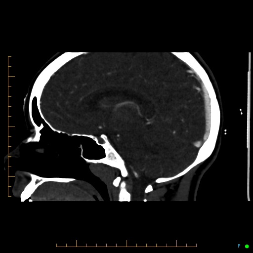 File:Cerebral arteriovenous malformation (AVM) (Radiopaedia 78162-90706 Sagittal CTA 44).jpg