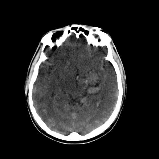 Cerebral arteriovenous malformation (Radiopaedia 28518-28759 Axial non-contrast 32).jpg