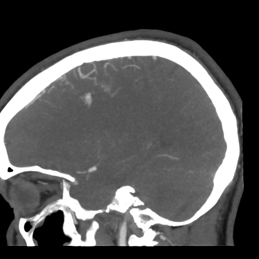 File:Cerebral arteriovenous malformation (Radiopaedia 39259-41505 Sagittal 21).png