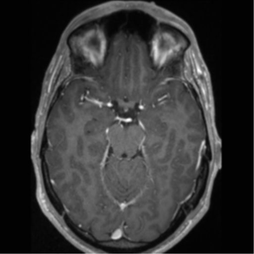 Cerebral arteriovenous malformation (Radiopaedia 55798-62372 Axial T1 C+ 28).png