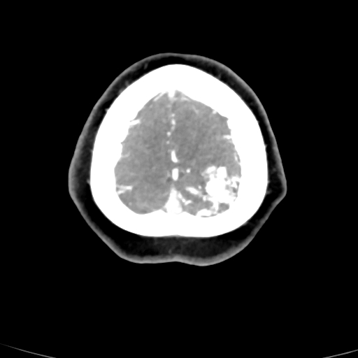 Cerebral arteriovenous malformation (Radiopaedia 73830-84645 B 10).jpg