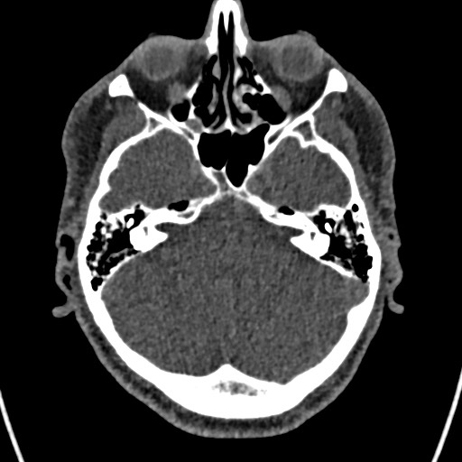 Cerebral arteriovenous malformation (Radiopaedia 78188-90746 Axial non-contrast 46).jpg