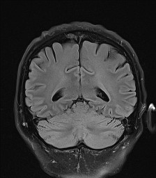 File:Cerebral arteriovenous malformation (Radiopaedia 84015-99245 Coronal FLAIR 24).jpg