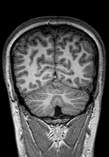 Cerebral arteriovenous malformation at posterior body of corpus callosum (Radiopaedia 74111-84925 Coronal T1 279).jpg