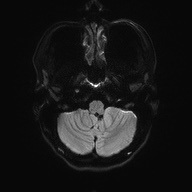 Cerebral cavernous venous malformation (Radiopaedia 70008-80021 Axial DWI 35).jpg