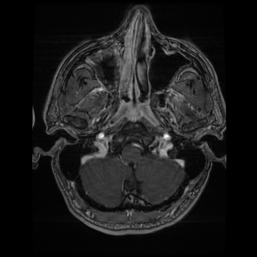 Cerebral cavernous venous malformation (Zabramski type II) (Radiopaedia 85511-101198 Axial T1 C+ fat sat 71).jpg