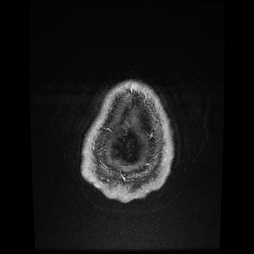 Cerebral cavernous venous malformation (Zabramski type II) (Radiopaedia 85511-101198 Axial T1 C+ fat sat 8).jpg
