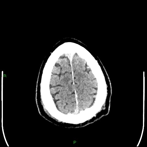 Cerebral contusions (Radiopaedia 33868-35039 Axial non-contrast 195).jpg