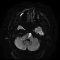 Cerebral embolic infarcts (embolic shower) (Radiopaedia 49837-55108 Axial DWI 85).jpg