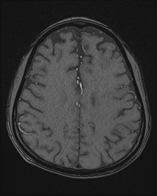 Cerebral embolic infarcts (embolic shower) (Radiopaedia 72391-82921 Axial MRA 142).jpg