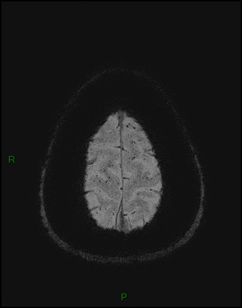 Cerebral fat embolism (Radiopaedia 35022-36525 Axial SWI 61).jpg
