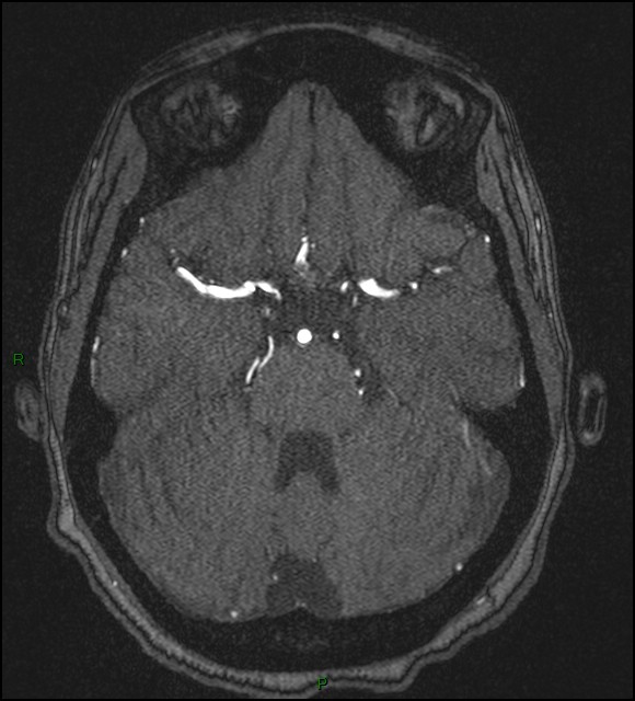Cerebral fat embolism (Radiopaedia 35022-36525 Axial TOF 64).jpg