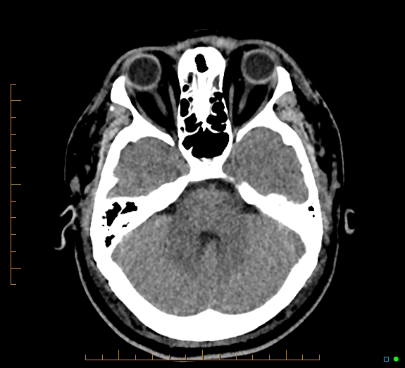 Cerebral fat embolism (Radiopaedia 85521-101224 Axial non-contrast 15).jpg