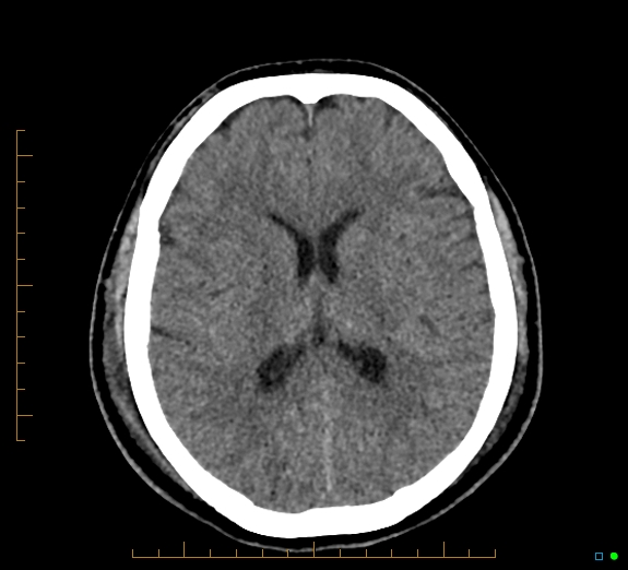 Cerebral fat embolism (Radiopaedia 85521-101224 Axial non-contrast 30).jpg