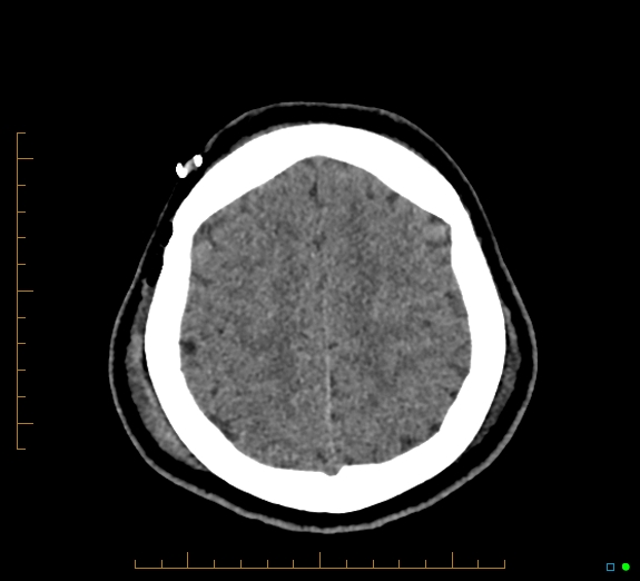 Cerebral fat embolism (Radiopaedia 85521-101224 Axial non-contrast 41).jpg