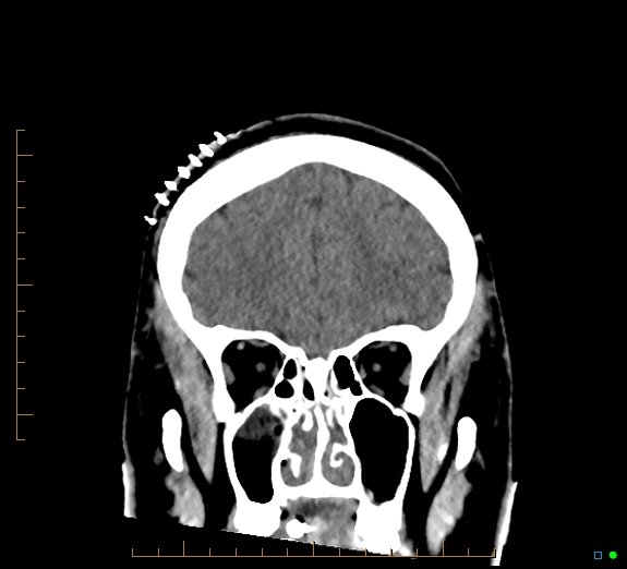 Cerebral fat embolism (Radiopaedia 85521-101224 Coronal non-contrast 17).jpg