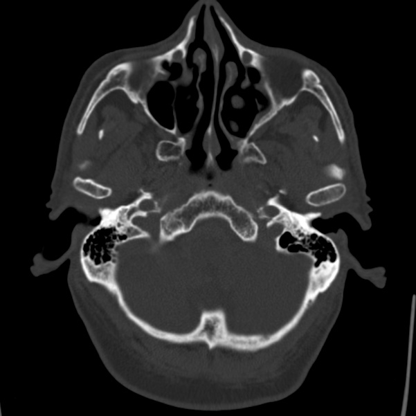Cerebral hemorrhagic contusions (Radiopaedia 23145-23188 Axial bone window 8).jpg