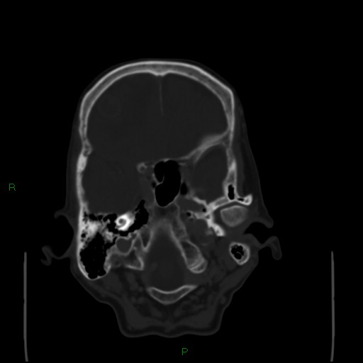 Cerebral metastases - breast primary (Radiopaedia 77653-89857 Axial bone window 26).jpg