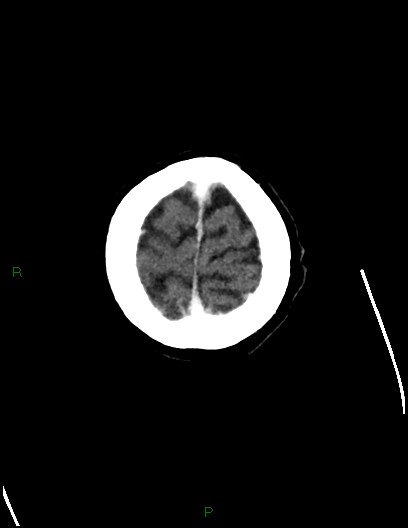 Cerebral metastases - ependymal and parenchymal (Radiopaedia 79877-93131 Axial C+ delayed 79).jpg