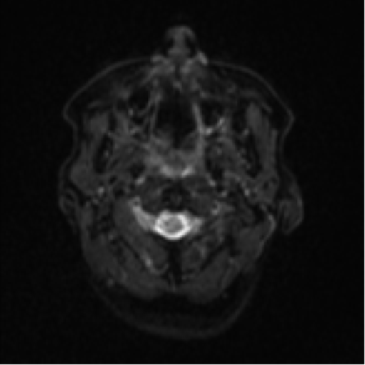File:Cerebral metastases mimicking abscesses (Radiopaedia 45841-50131 Axial DWI 1).png