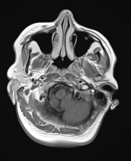 File:Cerebral metastases mimicking abscesses (Radiopaedia 45841-50131 Axial T1 C+ fat sat 4).png