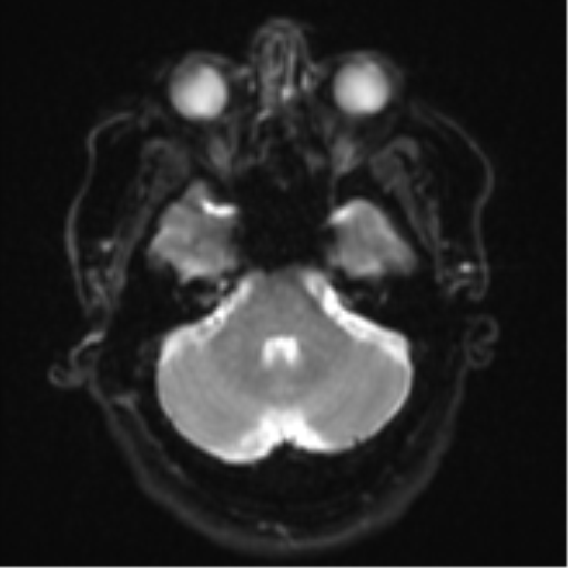 Cerebral metastases mimicking multifocal glioblastoma (Radiopaedia 50843-56353 Axial DWI 7).png