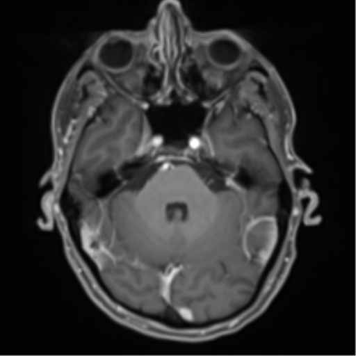 File:Cerebral metastasis - melanoma (Radiopaedia 54718-60954 Axial T1 C+ fat sat 16).png