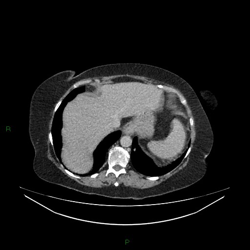 Cerebral metastasis from renal cell carcinoma (Radiopaedia 82306-96378 A 25).jpg