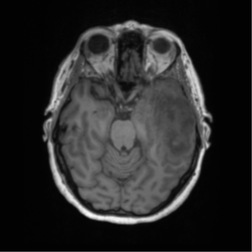 Cerebral metastasis mimicking glioblastoma (Radiopaedia 69155-78937 Axial T1 20).png