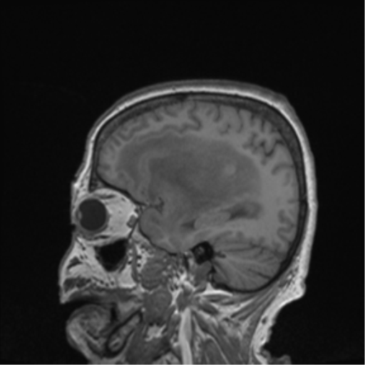 Cerebral metastasis to basal ganglia (Radiopaedia 81568-95413 Sagittal T1 56).png