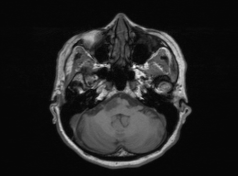 Cerebral ring enhancing lesions - cerebral metastases (Radiopaedia 44922-48817 Axial T1 307).jpg