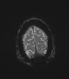 File:Cerebral toxoplasmosis (Radiopaedia 43956-47461 Axial SWI 36).jpg