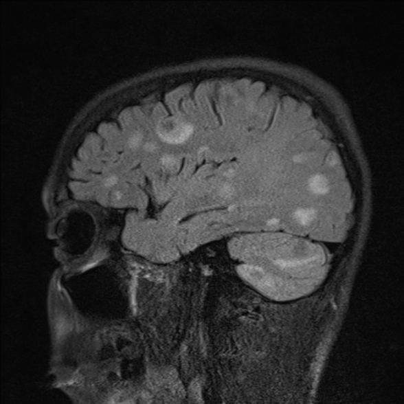 File:Cerebral toxoplasmosis (Radiopaedia 53993-60132 Sagittal FLAIR 8).jpg