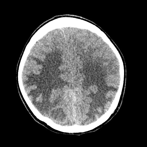 Cerebral tuberculosis with dural sinus invasion (Radiopaedia 60353-68018 Axial non-contrast 42).jpg