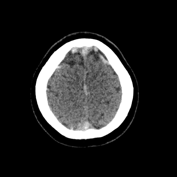 Cerebral venous sinus thrombosis (Radiopaedia 59224-66551 Axial non-contrast 46).jpg