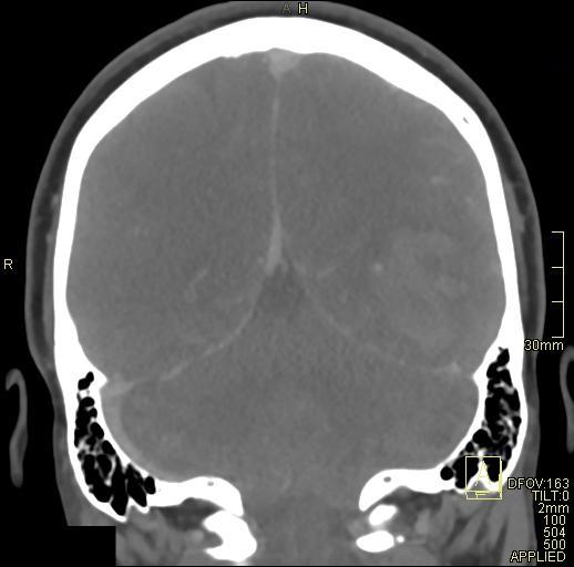 File:Cerebral venous sinus thrombosis (Radiopaedia 91329-108965 Coronal venogram 62).jpg