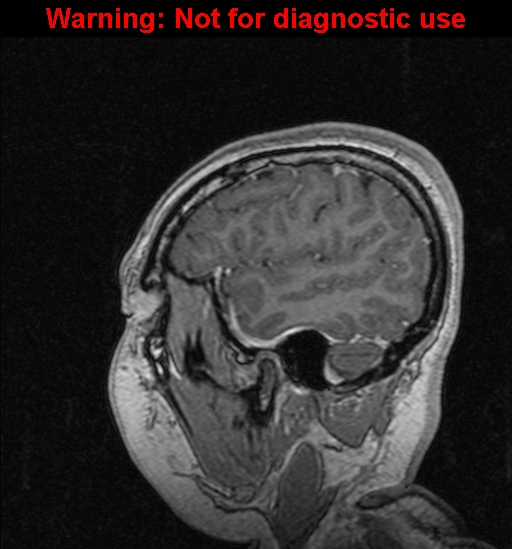 File:Cerebral venous thrombosis (Radiopaedia 37224-39208 Sagittal T1 C+ 29).jpg